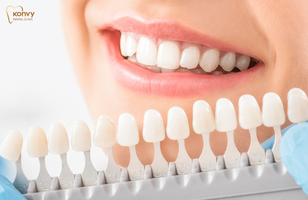 วีเนียร์ เซรามิก ดีกว่าแบบอื่นอย่างไร