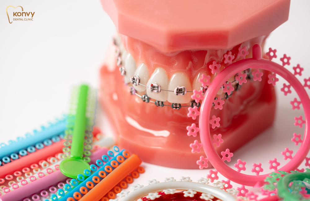 สียางจัดฟันยอดฮิต