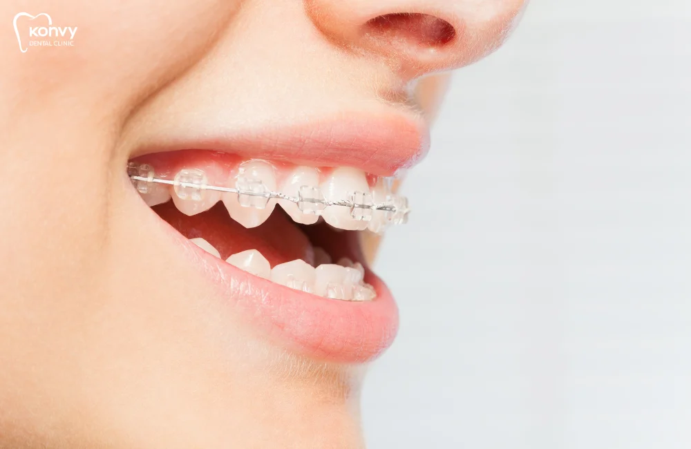 เปรียบเทียบชัด ๆ ข้อดี vs ข้อเสีย ของการจัดฟัน