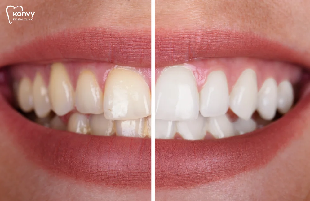 ฟันเหลืองแก้ยังไง_ รวมวิธีแก้ฟันเหลืองยอดนิยม