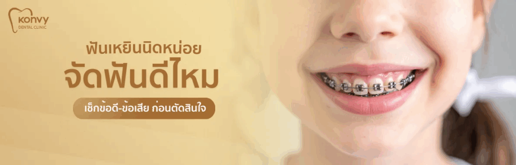 จัดฟันดีไหม? เช็กข้อดี ข้อเสีย ก่อนตัดสินใจ