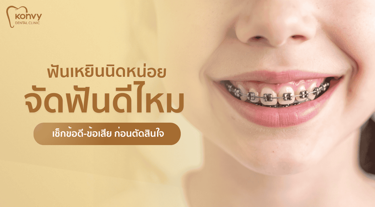 จัดฟันดีไหม? เช็กข้อดี-ข้อเสีย ฟันเหยินนิดหน่อยควรทำหรือเปล่า