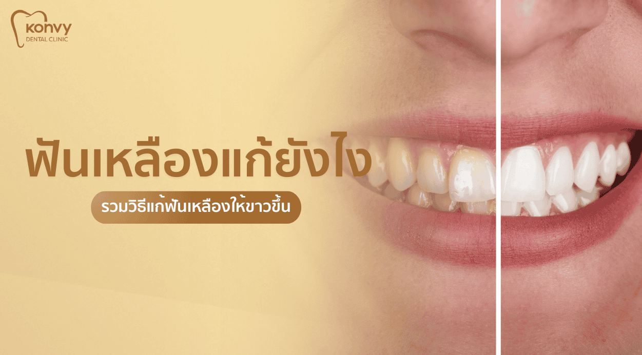 ฟันเหลืองแก้ยังไง? รวม 7 วิธีแก้ฟันเหลืองให้ขาว ปลอดภัย เห็นผลจริง