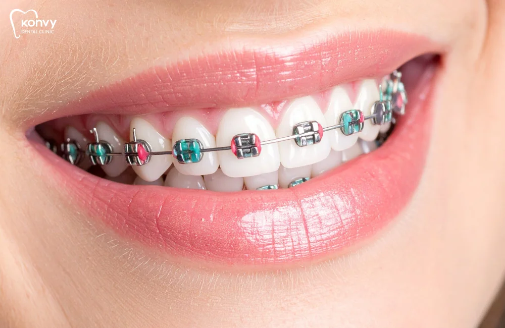 จัดฟันแบบโลหะ (Metal Braces)