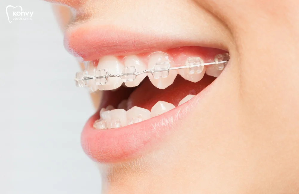 จัดฟันแบบเซรามิก (Ceramic Braces)
