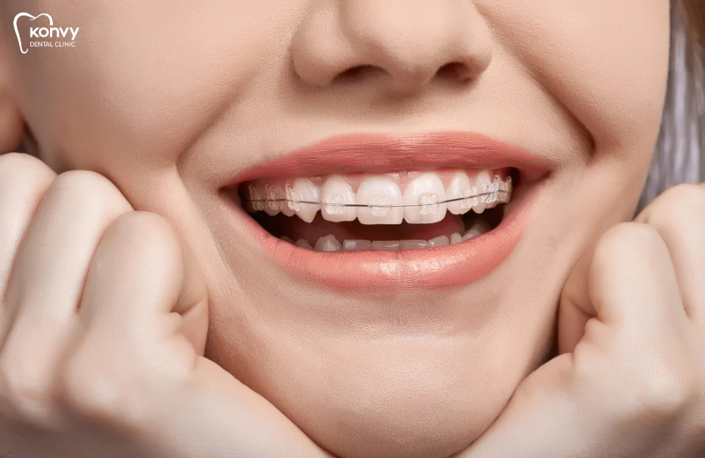 จัดฟันแบบดามอน (Damon Braces _ Self-Ligating)