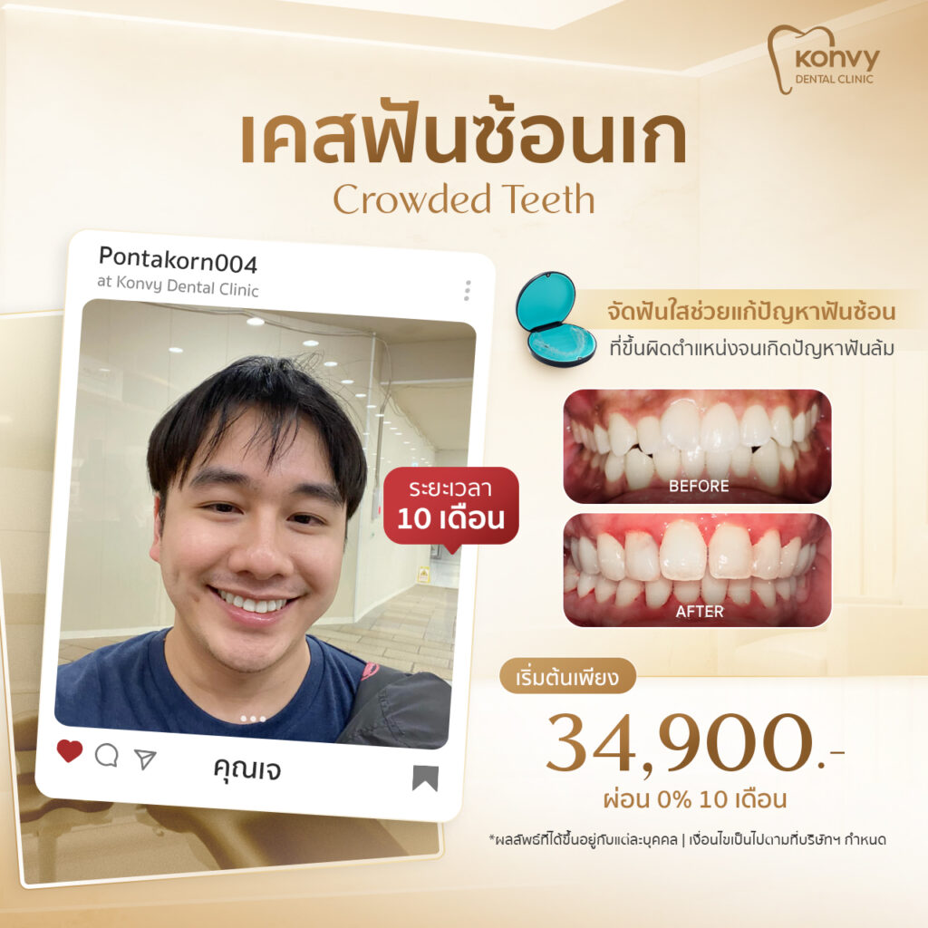 ฟันเรียงสวย ที่ Konvy Dental Clinic
